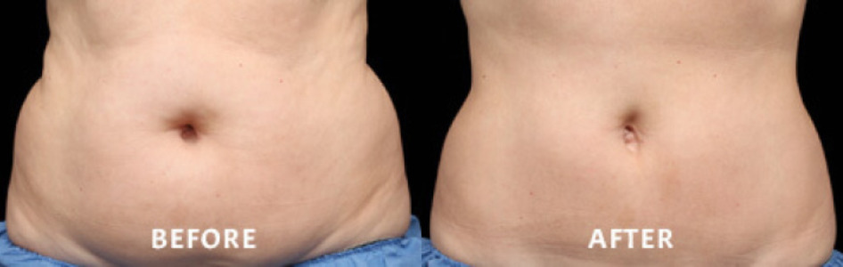 Coolsculpting Case 5 Image