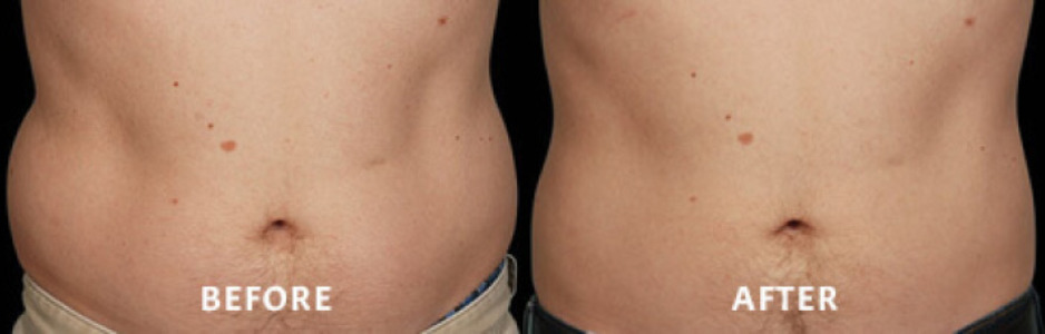 Coolsculpting Case 10 Image