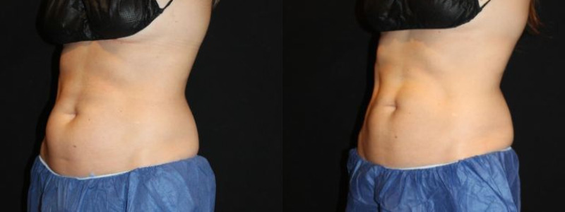 Coolsculpting Case 11 Image