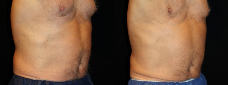 Coolsculpting Case 15 Image