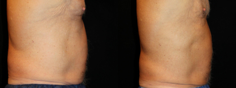 Coolsculpting Case 15 Image