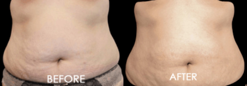 Exilis Ultra Case 2 Image