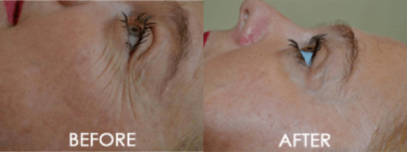 Exilis Ultra Case 3 Image