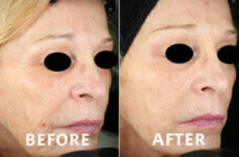 Fractional Radiofrequency Microneedling Case 3 Image