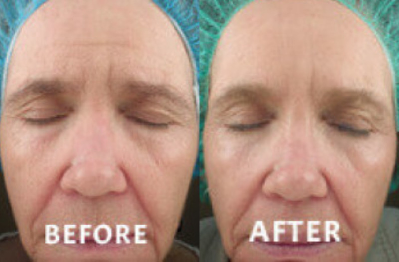 Fractional Radiofrequency Microneedling Case 1 Image