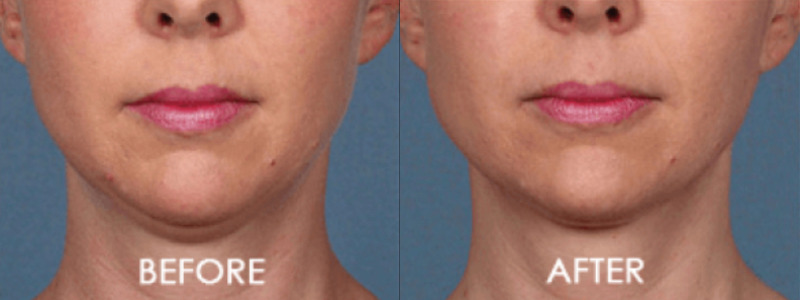 Kybella Chin Contouring Case 2 Image