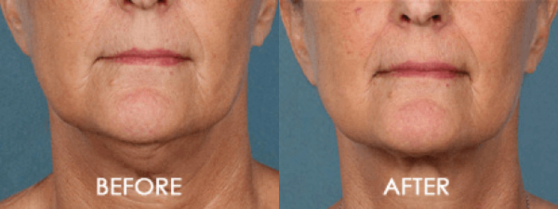 Kybella Chin Contouring Case 3 Image