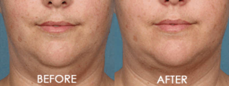 Kybella Chin Contouring Case 1 Image