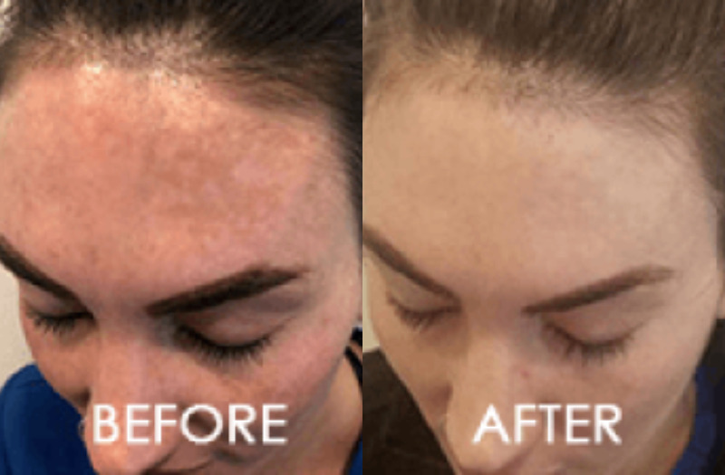 Laser Skin Resurfacing Case 1 Image