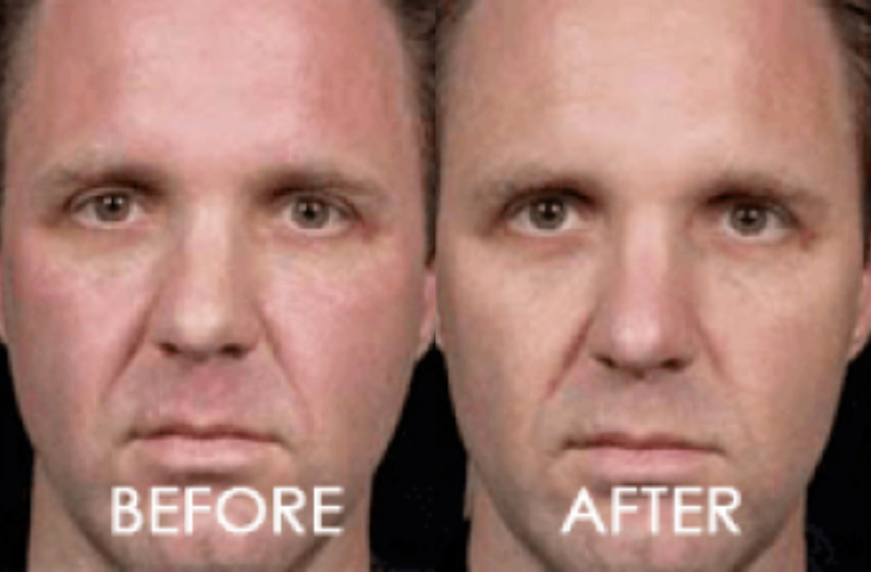 Laser Skin Resurfacing Case 4 Image