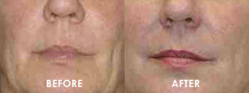 ThermageFLX Skin Tightening Case 3 Image