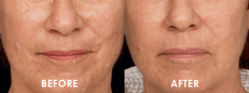 ThermageFLX Skin Tightening Case 1 Image