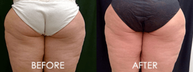 ZWave Cellulite Reduction Case 1 Image